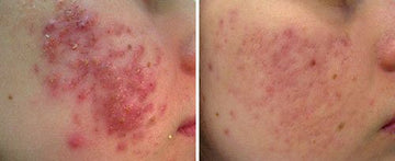 Active Acne Controlling