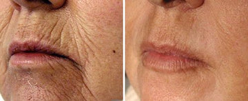 Fractional Skin Resurfacing