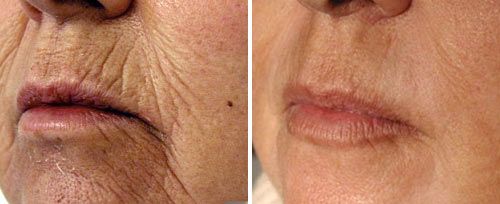 Fractional Skin Resurfacing
