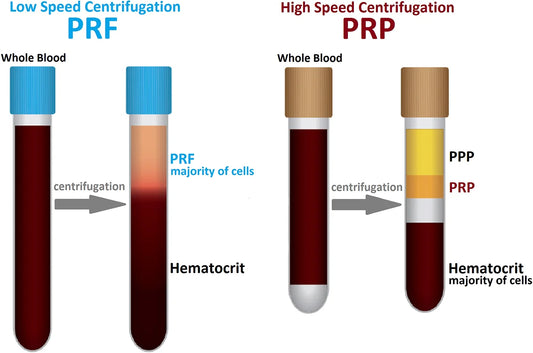 PRF: Platelet Rich Fibrin