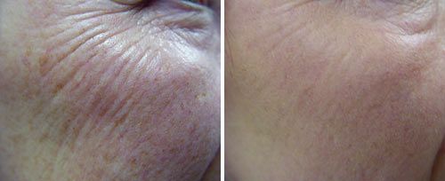 Fractional Skin Resurfacing