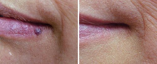 Rosacea: Vascular Lesions Removal