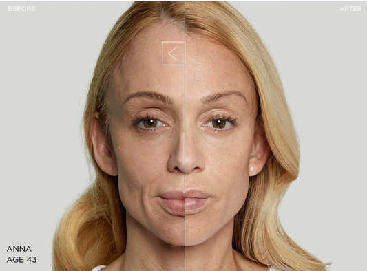 Sculptra® | Radiesse®