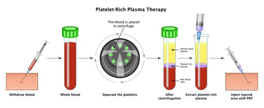 PRP: Platelet Rich Plasma