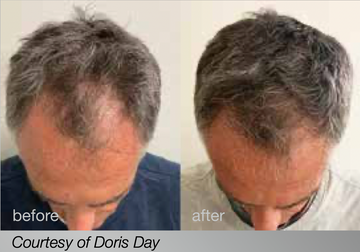 HAIRestart™ Growth Program