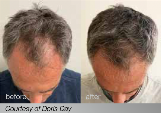 HAIRestart™ Growth Program