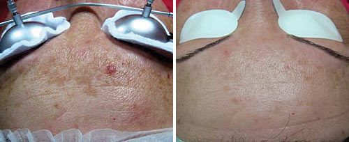 Benign Lesion Removal | Skin Tags Removal