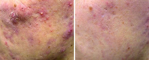 Active Acne Controlling