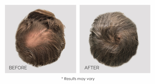 PRP Hair Restoration