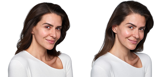 JUVÉDERM® SKINVIVE™